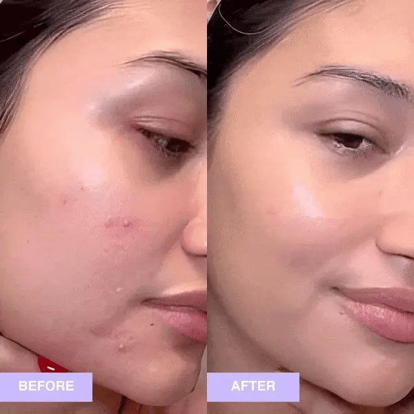 Acne-Vanish Pro (80% OFF TODAY ONLY)